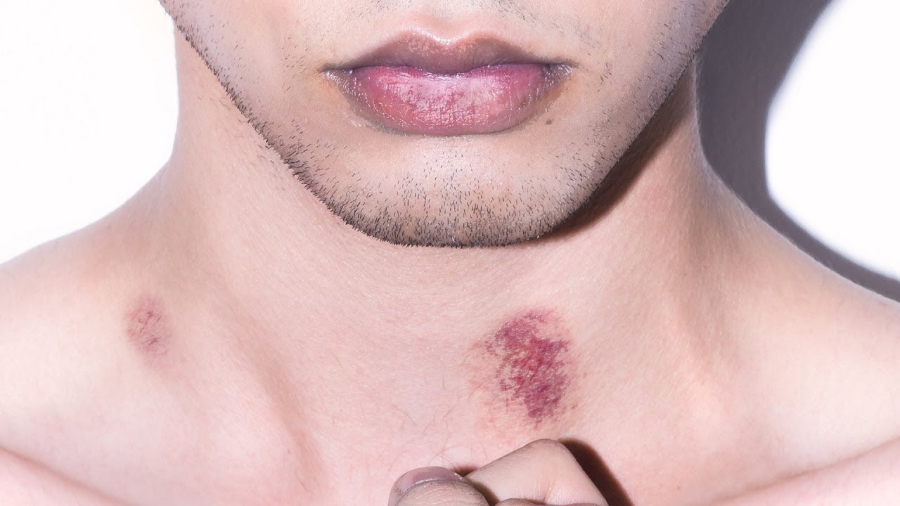 What Dermatologists Really Think of 9 Popular Hickey Removal Hacks | SELF