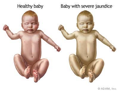 Newborn jaundice - Treatment - NHS