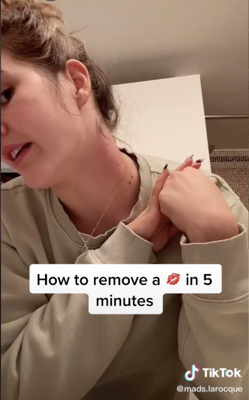 How to get rid of hickeys: only working methods.